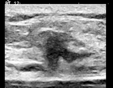 Follicular neoplasm of the thyroid on ultrasound