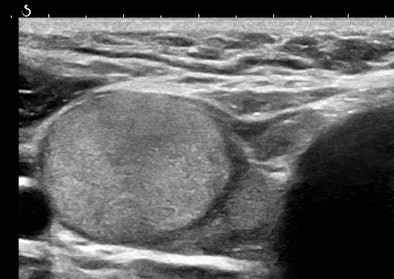 8-mm nodule in parenchyma on ultrasound