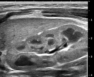 High-frequency US of infant kidney