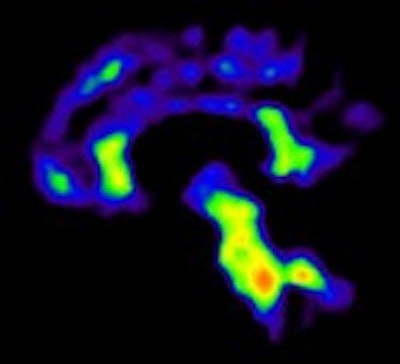The image on the left shows PiB binding (red) in the cortical regions of the brain to indicate the presence of amyloid plaque, while the image on the right shows PiB binding to white matter (red), which signifies a negative result. All images courtesy of Dr. Rik Ossenkoppele.
