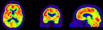 FDG-PET images show a normal brain (top) with normal functions (red) compared with an abnormal brain (bottom) with a diagnosis of Alzheimer's and lack of FDG uptake (yellow and green).