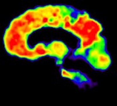 PiB binding (red) in the cortical regions of the brain to indicate the presence of amyloid plaque