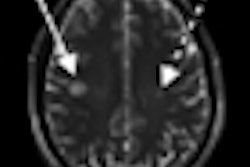 2012 07 16 14 39 44 113 2012 07 17 Sodium Mri Ms Thumb