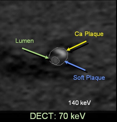Mixed plaque image at DECT