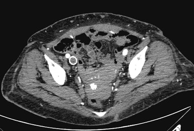 Incidental right iliac venous stent