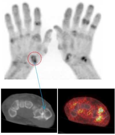 PET/CT of osteoarthritis