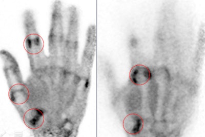 PEM of osteoarthritis
