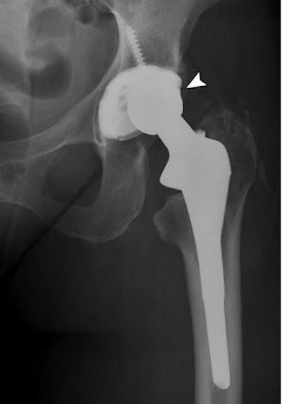 Frontal radiograph of pelvis shows disassociation of polyethylene liner from its acetabular cup (arrowhead) in total hip replacement in 65-year-old woman.