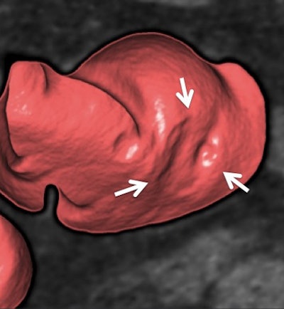 Flat colon polyp at CTC