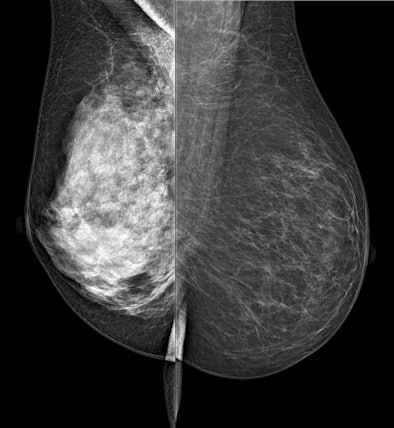Spectral mammography
