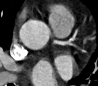 Filtered back projection reconstruction