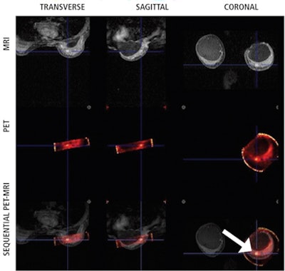 Silicone implant with carcinoma