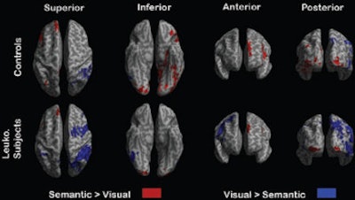 Signal variation in leukoaraiosis versus control patients