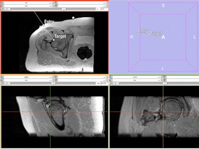 Needle path planning to the femoral head-neck junction