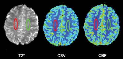 MRI multiple sclerosis