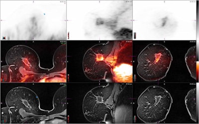 PET/MRI of breast of woman in her 50s