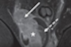 2012 08 29 13 56 57 544 2012 08 30 Mri Testicular Cancer Thumb