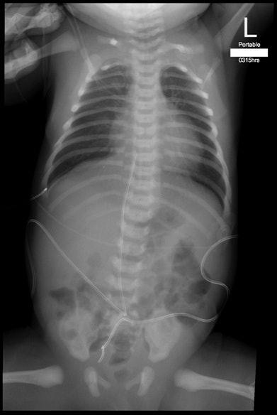 Fingers of NICU staff visible in image