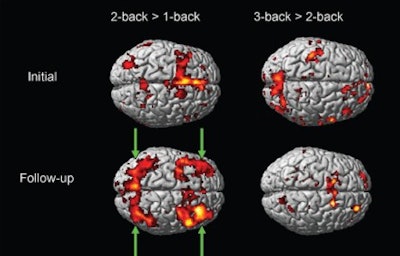 fMRI shows brain activation