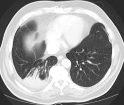Ct Lung