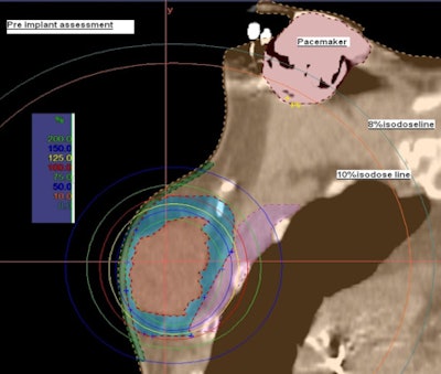 SAVI preimplant assessment