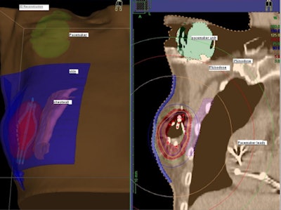 3D reconstructed view of the implanted SAVI device