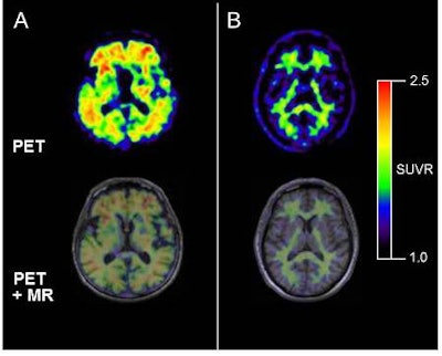 Axial florbetaben brain PET and MRI