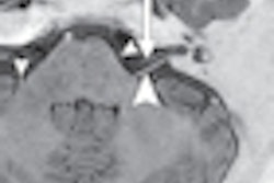 2012 09 18 15 19 21 699 2012 09 19 Stir Mri Thumb