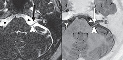 A 70 Year Old Woman With Lung Cancer And No Brain Metastasis