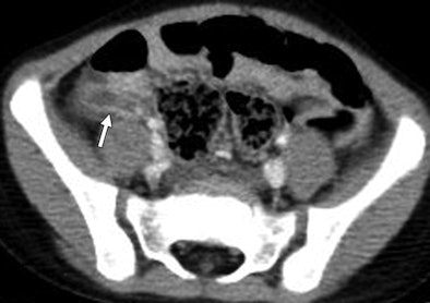 Pelvic CT of 4-year-old