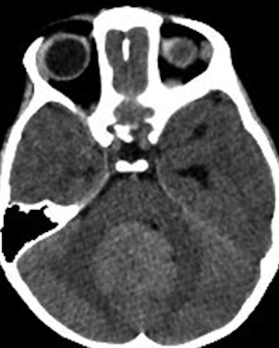 CT scan through posterior fossa and temporal lobes of 3-year-old boy. Radiologist at outside referring institution initially diagnosed hydrocephalus, whereas specialty radiologist at tertiary care hospital recognized posterior fossa tumor as cause of hydrocephalus. All images courtesy of the American Roentgen Ray Society.