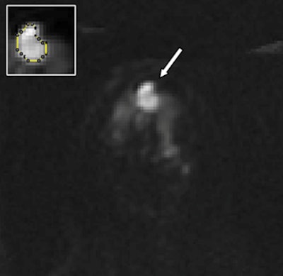 Diffusion-weighted breast MRI