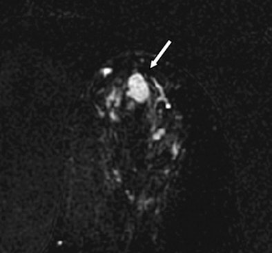 Contrast-enhanced breast MRI