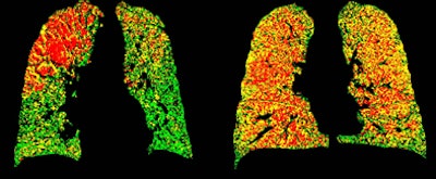 PRM attenuation-based analysis of CT data shows normal lung voxels in green, yellow voxels as small airway disease, and red as COPD. Above, image at left shows a large area of COPD in red in the upper left lobe, while the image at right is dominated by yellow voxels depicting functional airway disease interspersed with red voxels indicating COPD. Patients with diffuse small airway disease (yellow) may be better candidates for pharmacologic rather than surgical treatment approaches, while more invasive therapies such as lung reduction or lung transplantation might be reserved for patients with large COPD (red) components. Below, left image shows mostly normal lung tissue color-coded in green, while right image shows evidence of diffuse small-airway disease. All images courtesy of Dr. Ella Kazerooni and the University of Michigan.