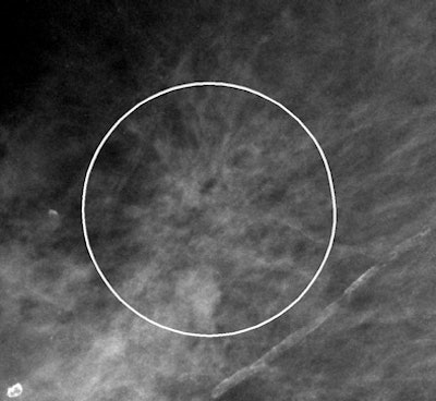 VuCOMP mass mark on architectural distortion