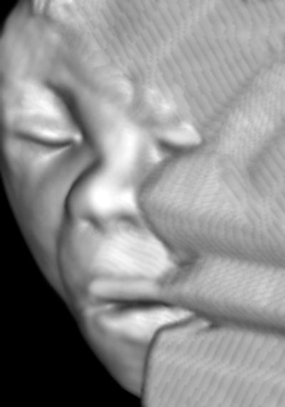 Figure 1: 3D image of a healthy 19.6-week male fetus. All images courtesy of Dr. Jason Birnholz.