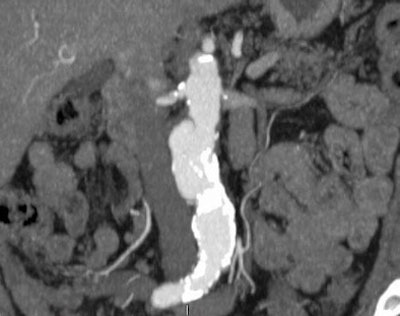 AAA detected at virtual colonoscopy