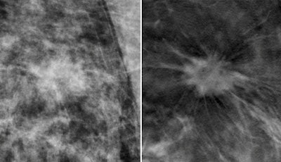 Digital mammo and tomo images of DCIS
