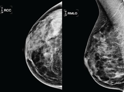 2012 12 03 14 58 46 127 Ibrahim 51 Yearly Mammo 450