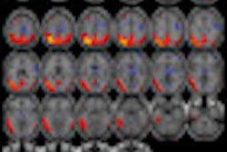 2012 12 11 10 07 12 730 Shaffer Mri Pet Alz Thumb