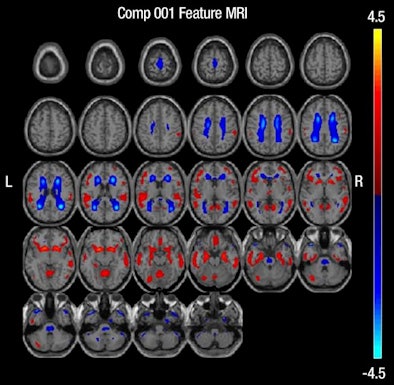 2012 12 11 10 07 13 160 Shaffer Mri Alz 394