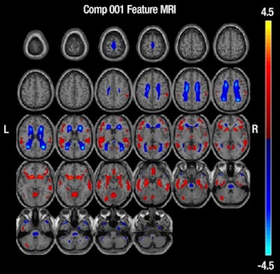 2012 12 11 10 07 13 160 Shaffer Mri Alz 394