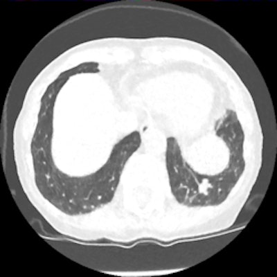 Screening CT of a 74-year-old woman with a 48 pack-year history of smoking. Nodule is seen at ultralow-dose CT (0.2 mSv) using model-based iterative reconstruction (GE Healthcare). Image courtesy of Dr. Ella Kazerooni.