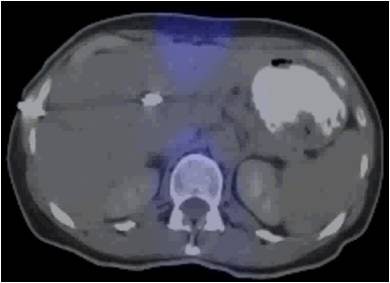 CT for radiotherapy planning