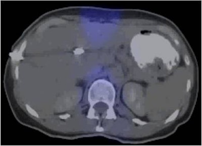 CT for radiotherapy planning