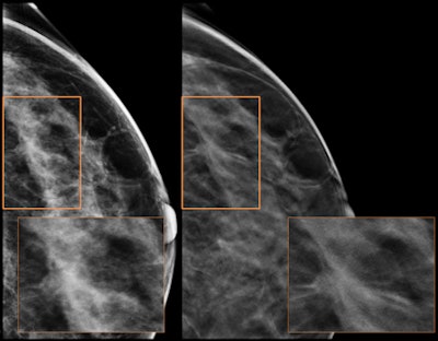Tomosynthesis shows spiculated mass