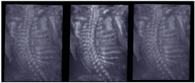 3D-acquired fetal spine