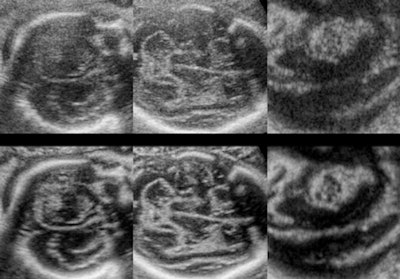 Fetal brain images
