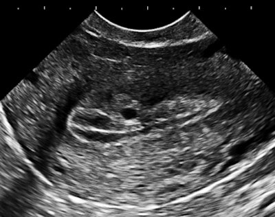 Endovaginal ultrasound