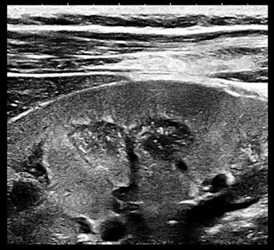 Ultrasound of right kidney